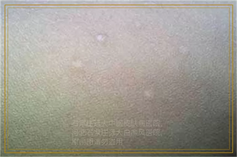 儿童手指白癜风能做种植吗