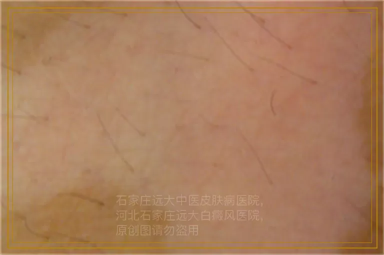 怎么治疗儿童刚发现的白癜风