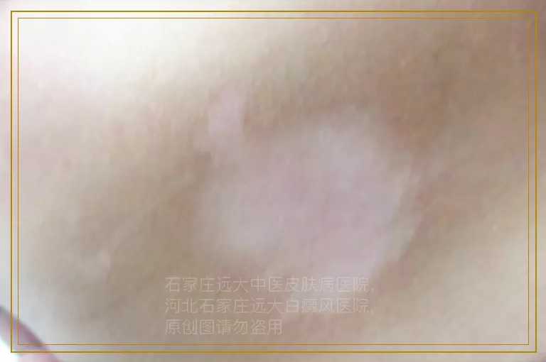 儿童白癜风治疗一般要怎样