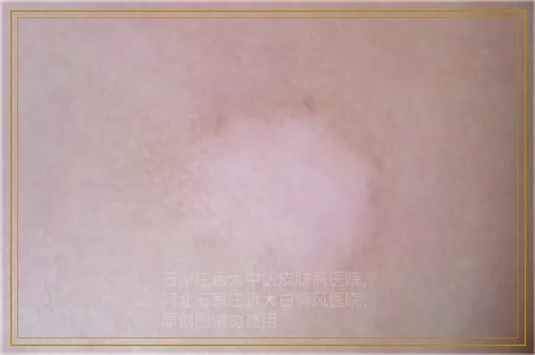 儿童身上多处有白斑一定是白癜风吗