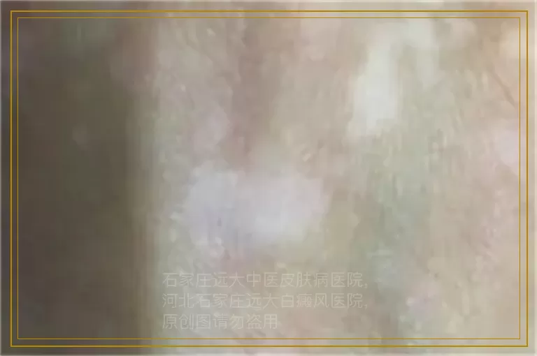 小孩脸上有白色点点是什么原因