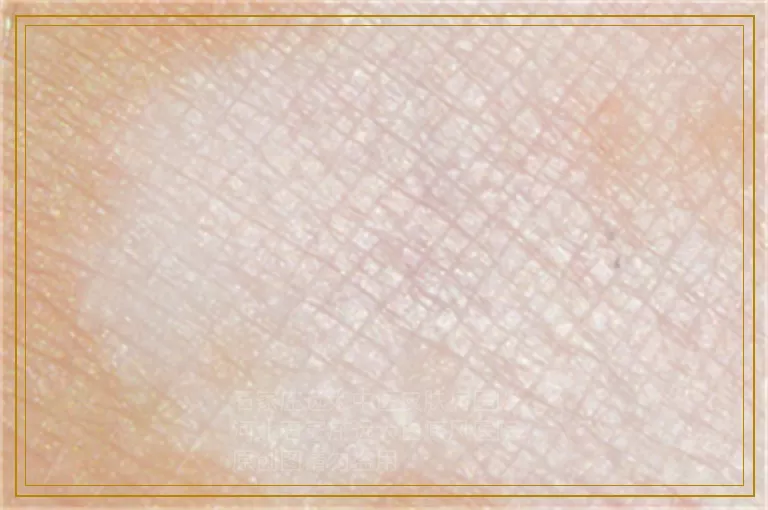 孩子得了白癜风需要注意哪些