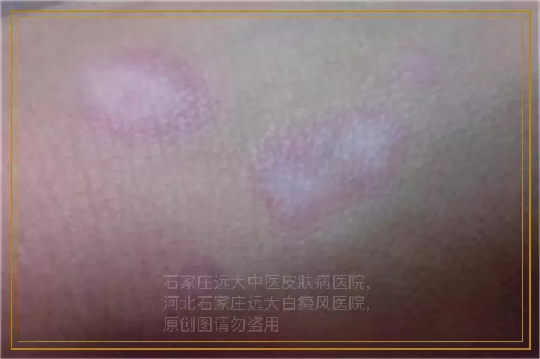 宝宝出生肚皮上有白斑是胎记还是白癜风