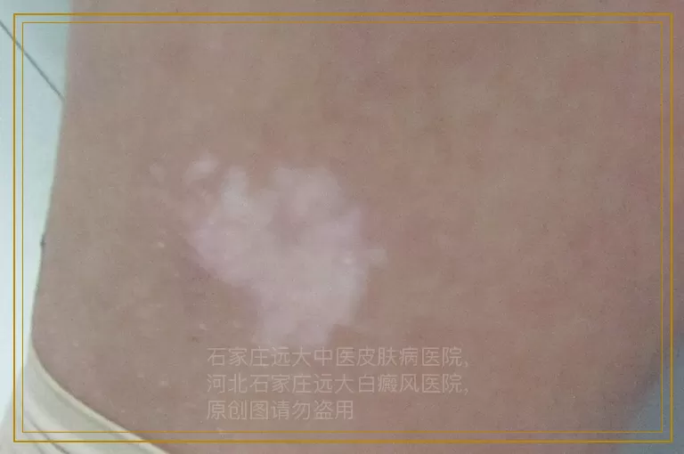 儿童得了白癜风要怎么治