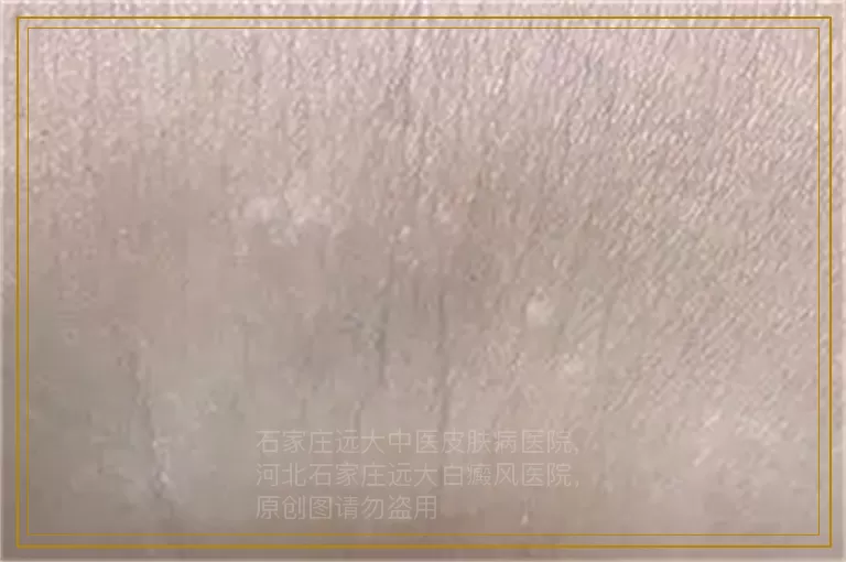 三岁小孩头上有白斑能治好吗