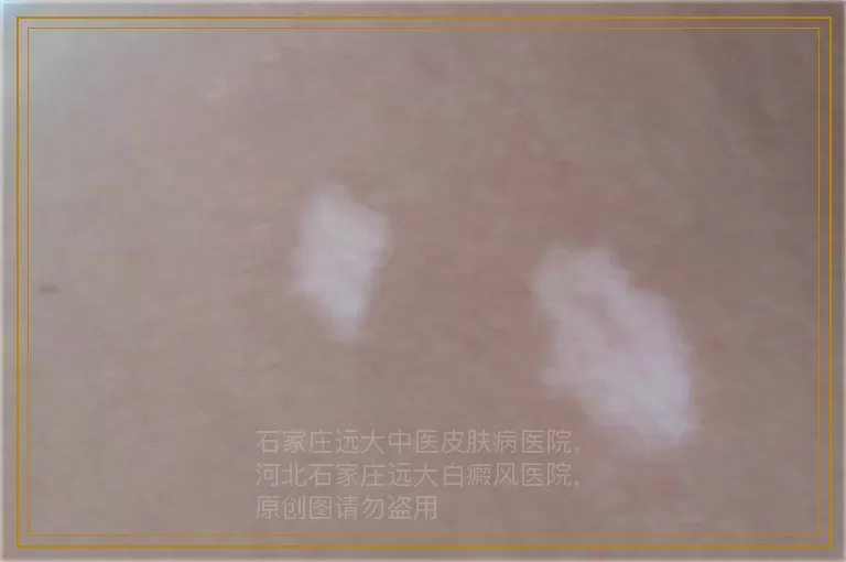 婴儿眉毛上出现一点白癜风怎么治