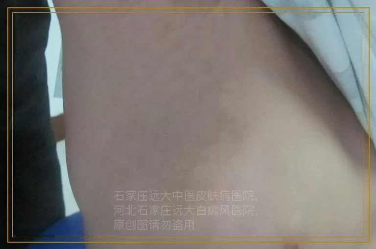 孩子嘴角上的白斑要怎么办