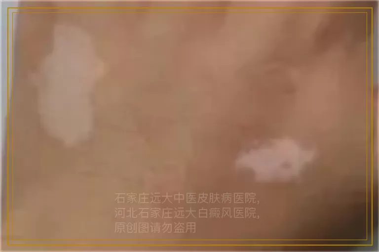 9岁女童初期白癜风治疗需要多久