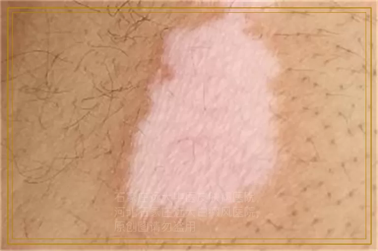 哪些因素会造成孩子的白癜风发病