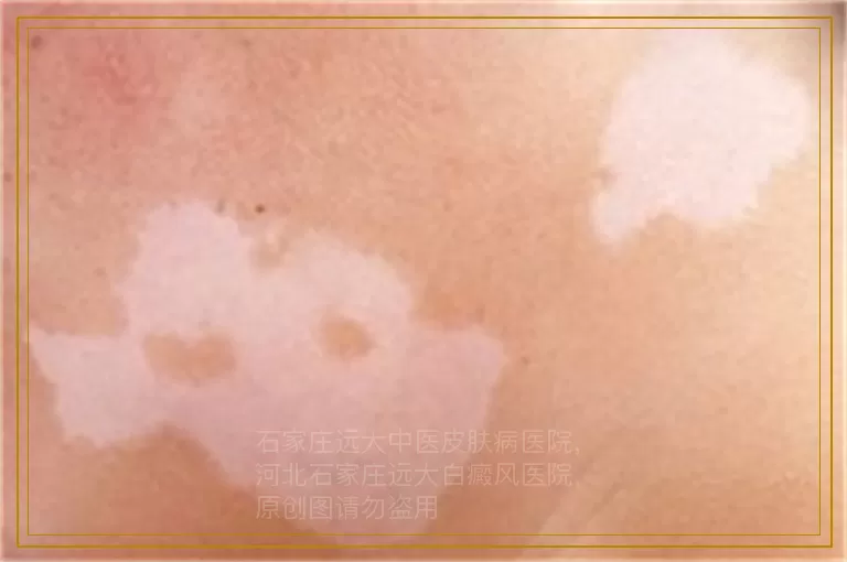 小孩子有白癜风多长时间能治好