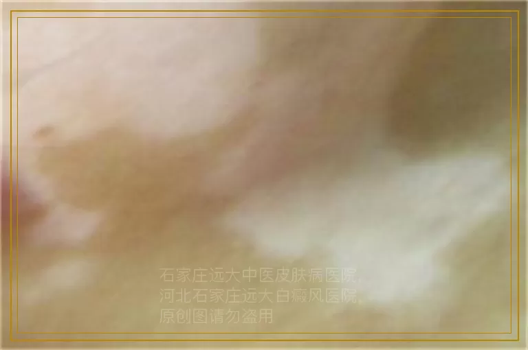 宝宝小腿上有白色的点点是什么原因