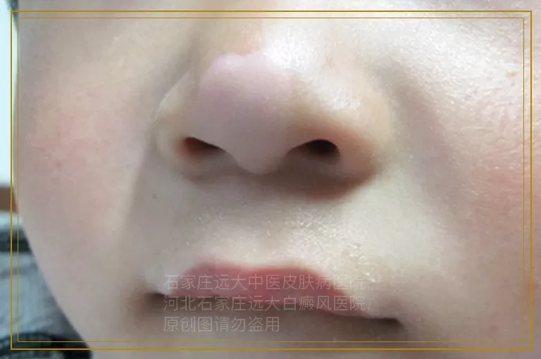 婴儿脸上有一片片白的可能是白癜风吗