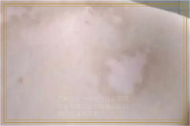 小孩脸上有淡白斑图片