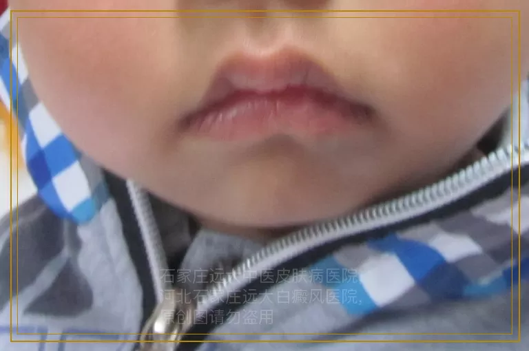 孩子比较挑食得了白癜风吃什么好