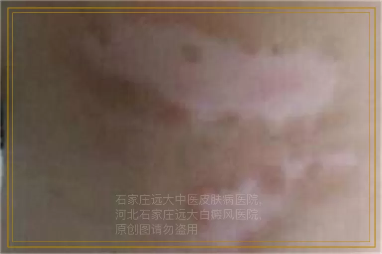 8岁男孩身上出现白点点是什么