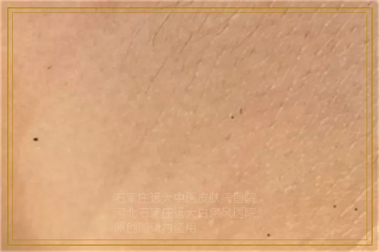 儿子的白癜风激光不见好怎么办