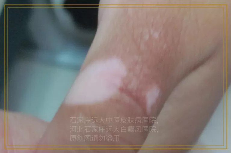 治疗儿童白癜风很久无变化能中断吗