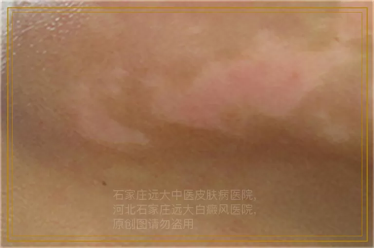 儿童脸上一块儿光滑的白块是怎么了