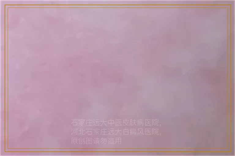 小孩白癜风初期面积小只用药能好吗