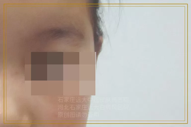 儿童白癜风治疗早期要怎么做