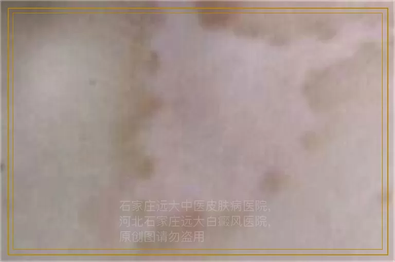 孩子皮肤白一块 白斑是什么原因引起的