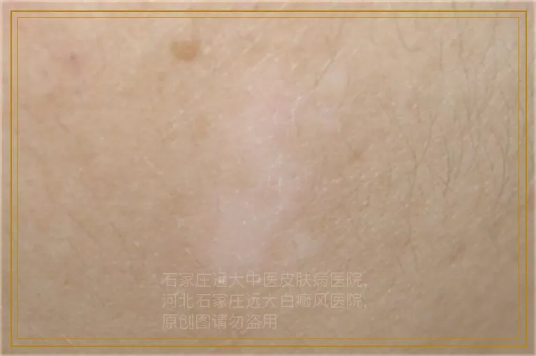 孩子脸上长了一块白斑不知道是不是白癜风