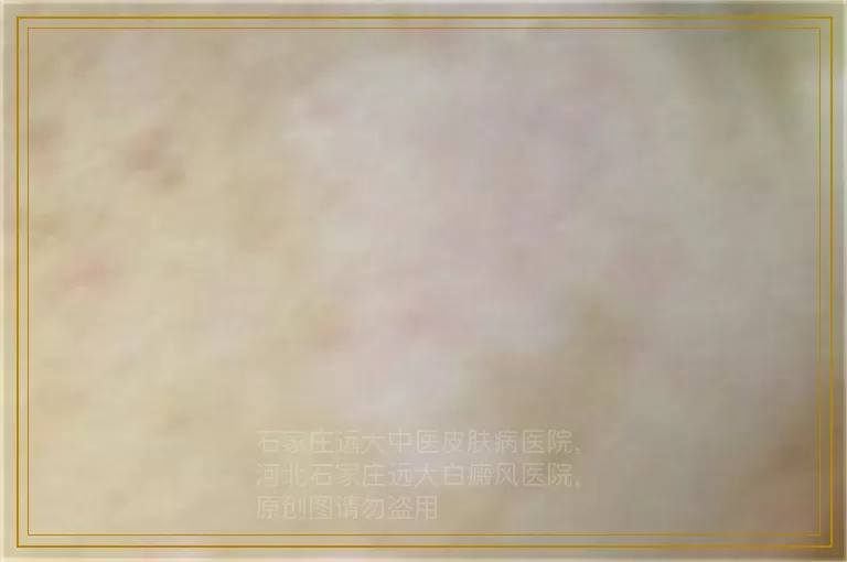 孩子白癜风是不是遗传的那