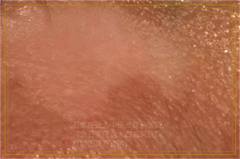 宝宝腰部长白斑能吃药治疗吗