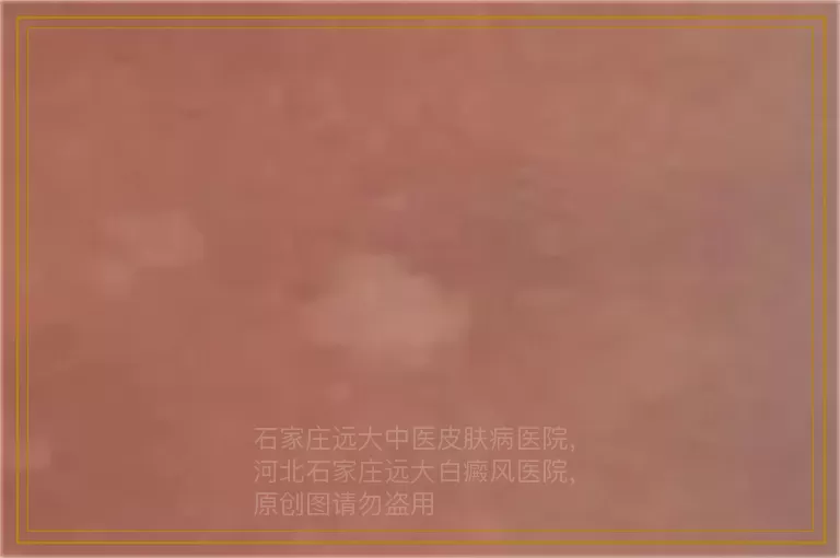 两岁宝宝白癜风可以做种植手术吗