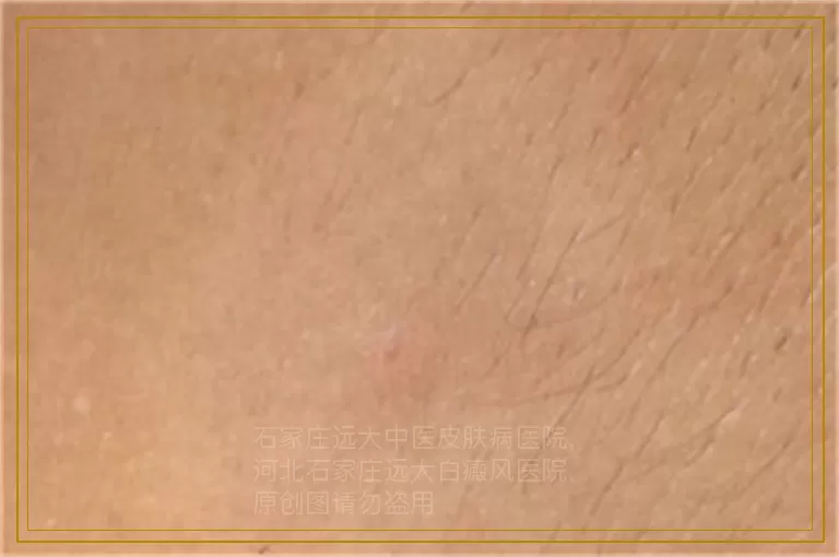 儿童面颊皮肤发白的原因有哪些