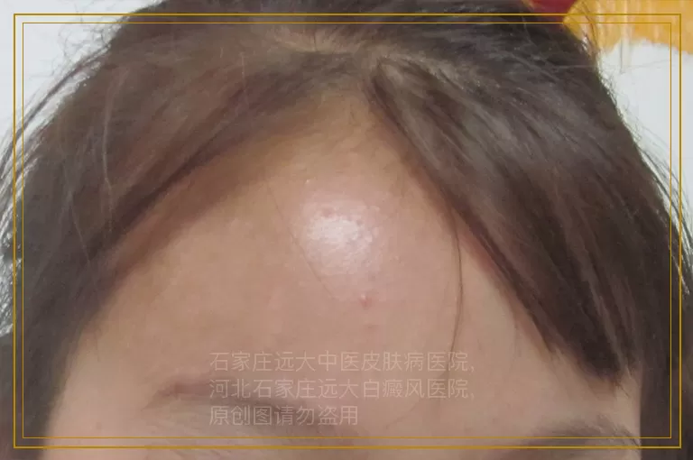 宝宝眼周长小白点是怎么回事