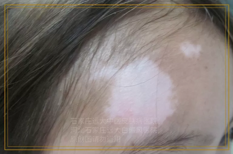 儿童阶段性白斑照308nm激光能治疗好吗