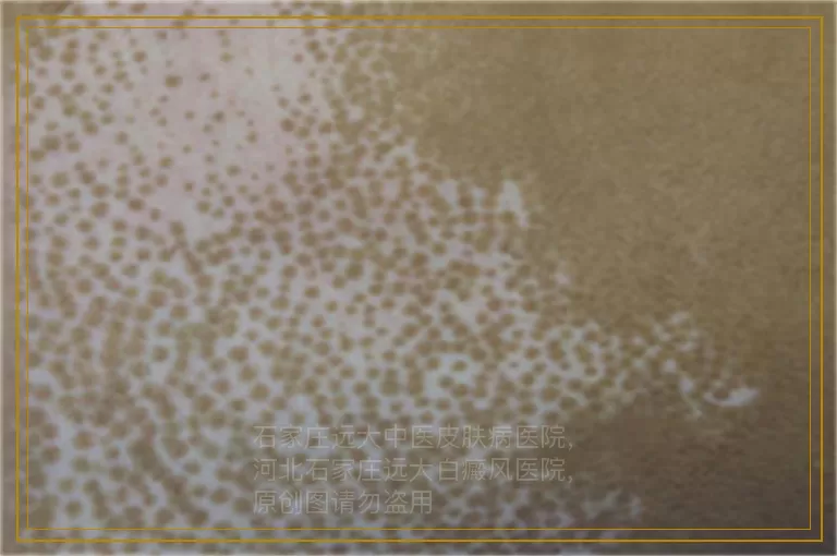 四岁孩子白癜风照美国308隔几天一次