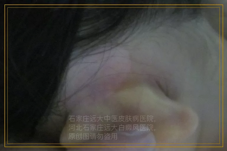 小孩胳膊上有白色块是什么原因