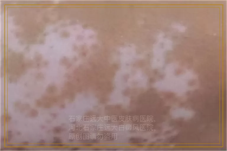 儿童治疗白癜风需要多少治疗费用