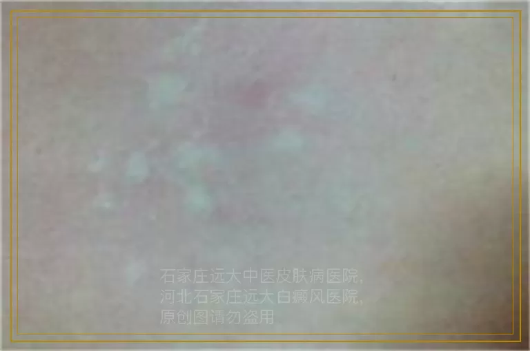 宝宝大腿根有一块白色斑点