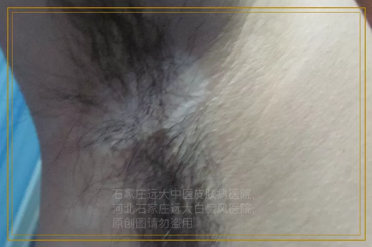 孩子身上老长白斑到底是怎么回事