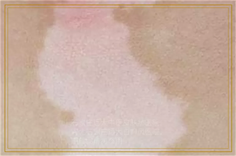 儿童面部长白斑是白癜风的症状吗