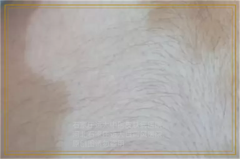 孩子眼睛下面有几个小白斑是什么