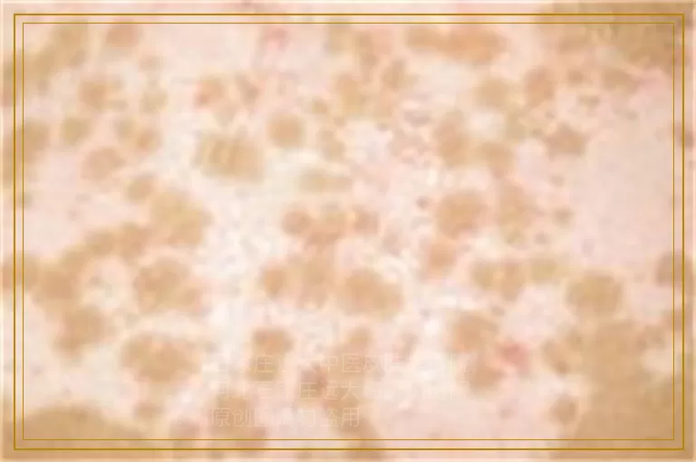 幼儿白癜风在下巴怎么治