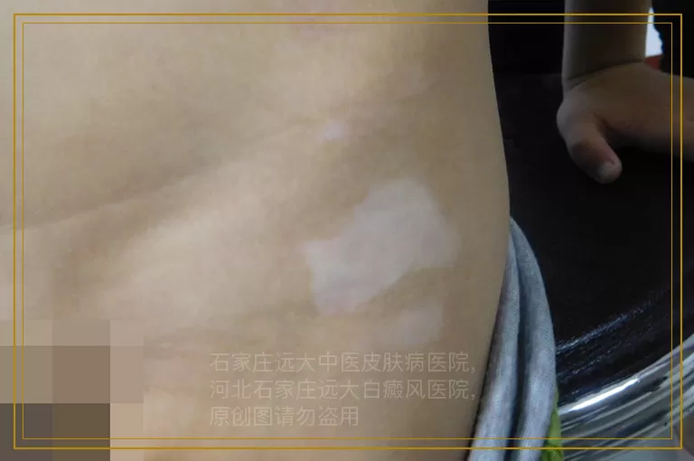 当下得白癜风的人越来越多是怎么回事