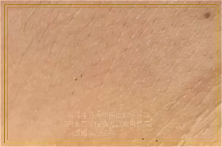 儿童患有白癜风什么年龄段适合治疗