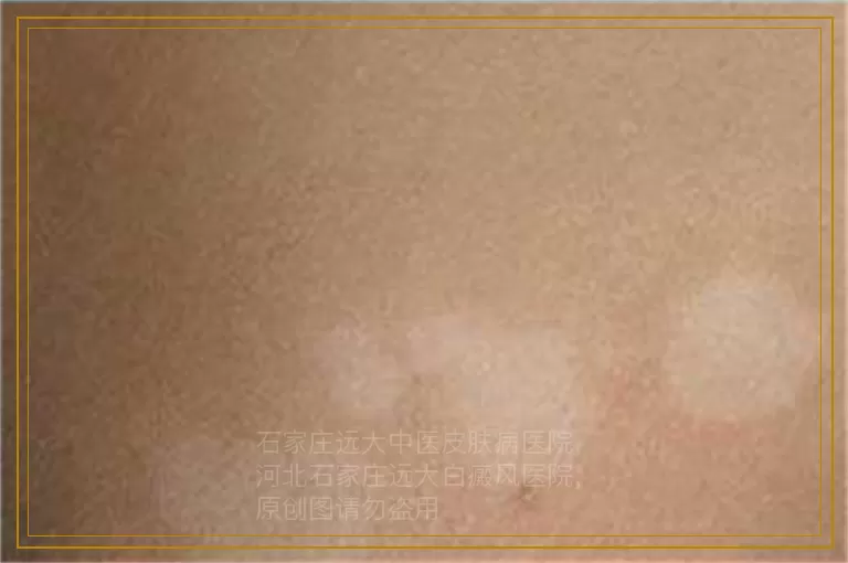 308激光治疗儿童白斑复发吗