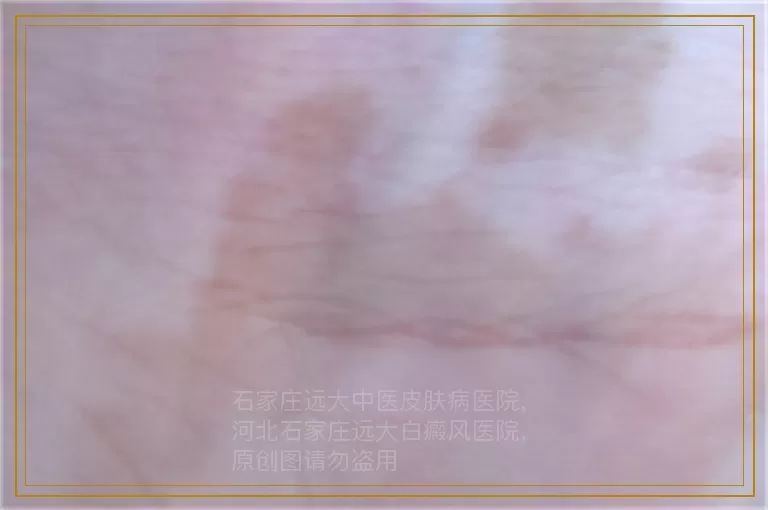 白癜风表皮移植手术需谨慎