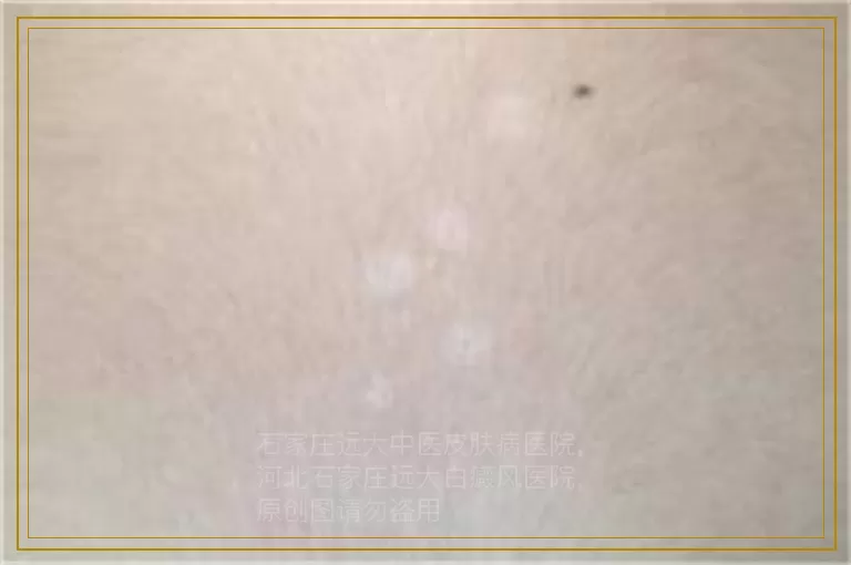 适合儿童白癜风的药膏都有哪些