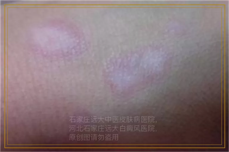 小孩身上长了一点一点白色的是什么