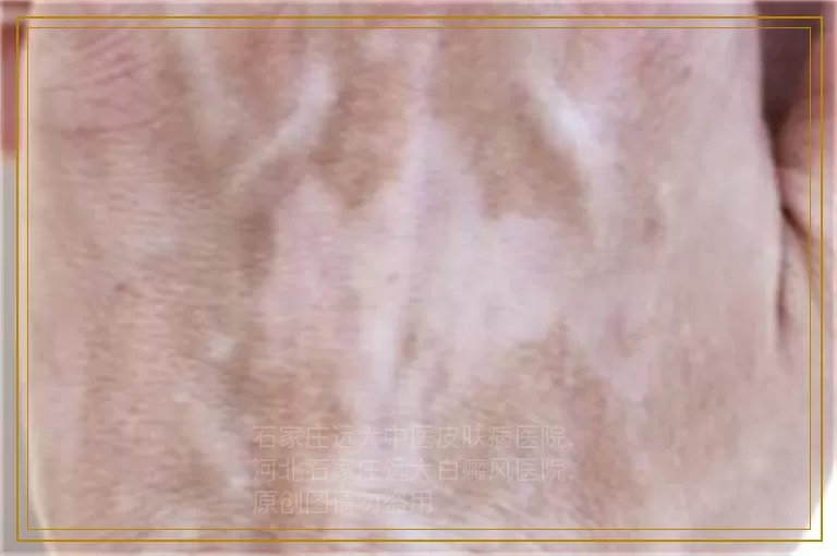 孩子身上忽然有一块不规则白斑