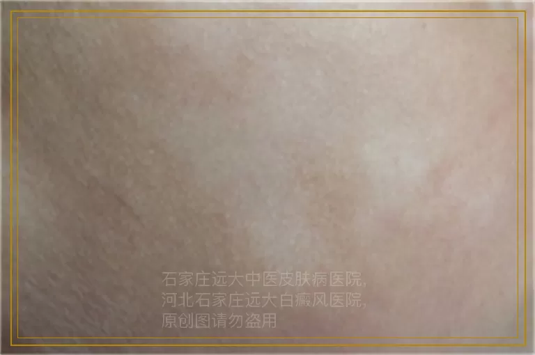 儿童白癜风早期用什么方法治疗快