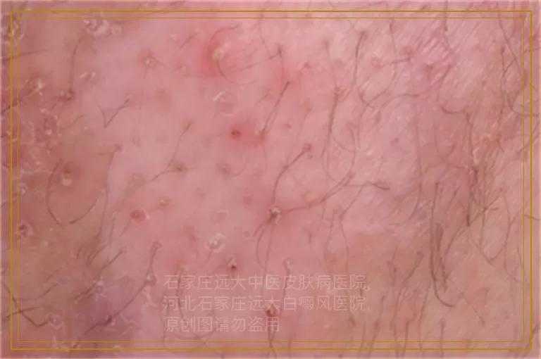 孩子脸上有白块是怎么回事