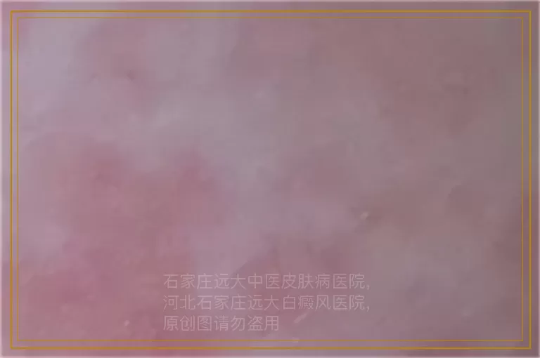 刚刚出生的宝宝有白癜风怎么办